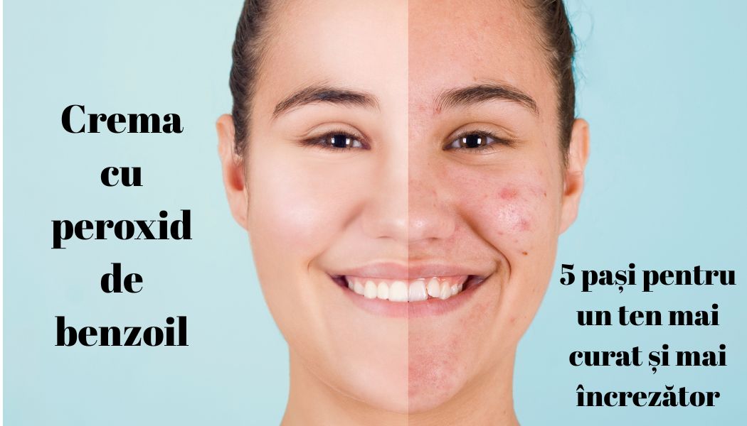 Crema cu peroxid de benzoil – 5 pași pentru un ten mai curat și mai încrezător